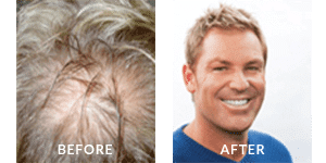 Shane Warne Before After Hair Loss