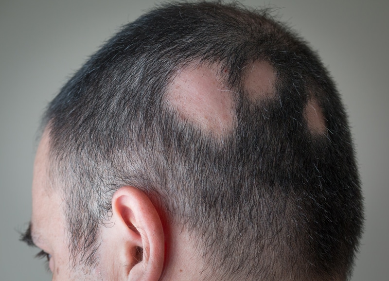 Alopecia Areata Hair Loss Treatment, Causes & Cure Australia