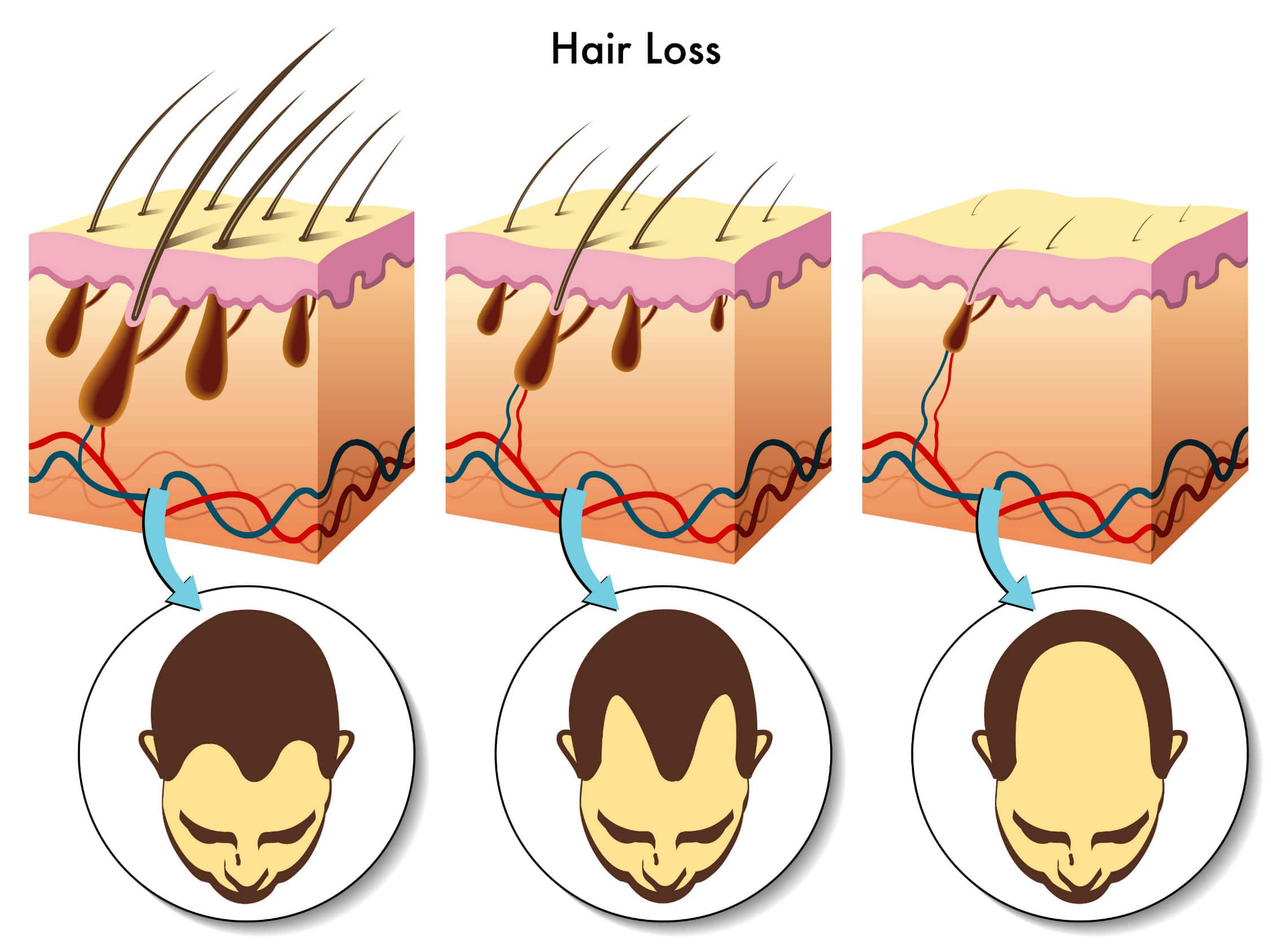Infected Hair Follicles Treatment To Prevent And Stop Hair Loss