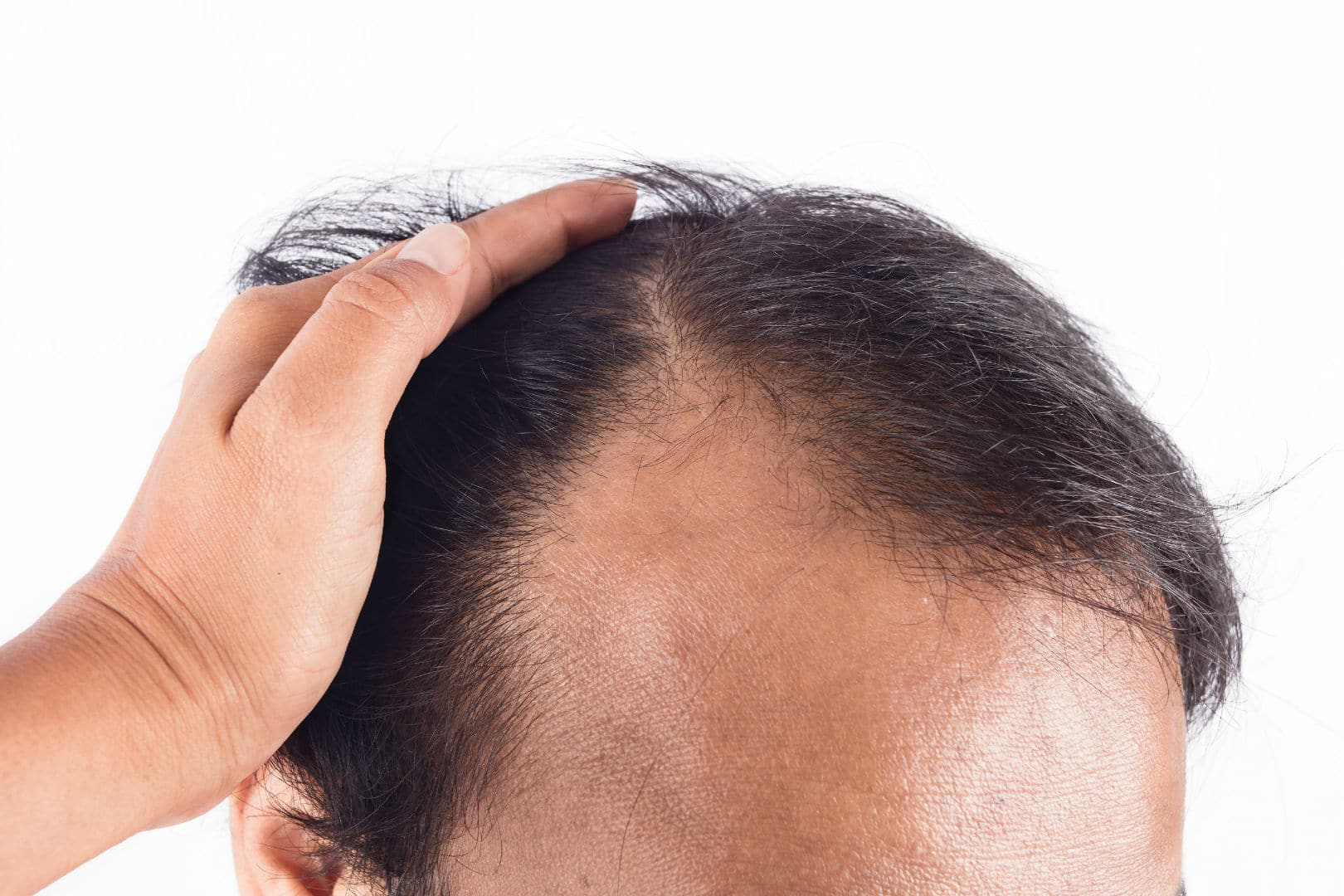 Bald Spot On The Back Of Head How To Prevent Treat Hair Loss