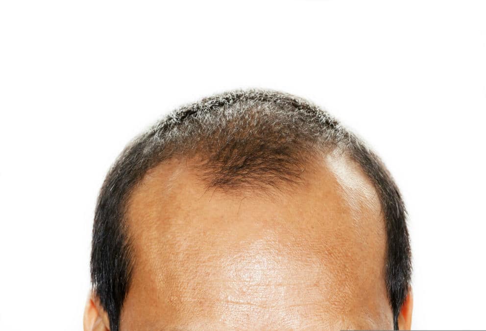thinning hair top of head