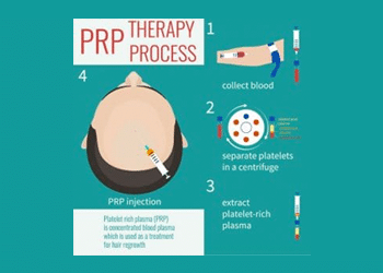 What is PRP Treatment - Therapy Procedure For Hair Loss