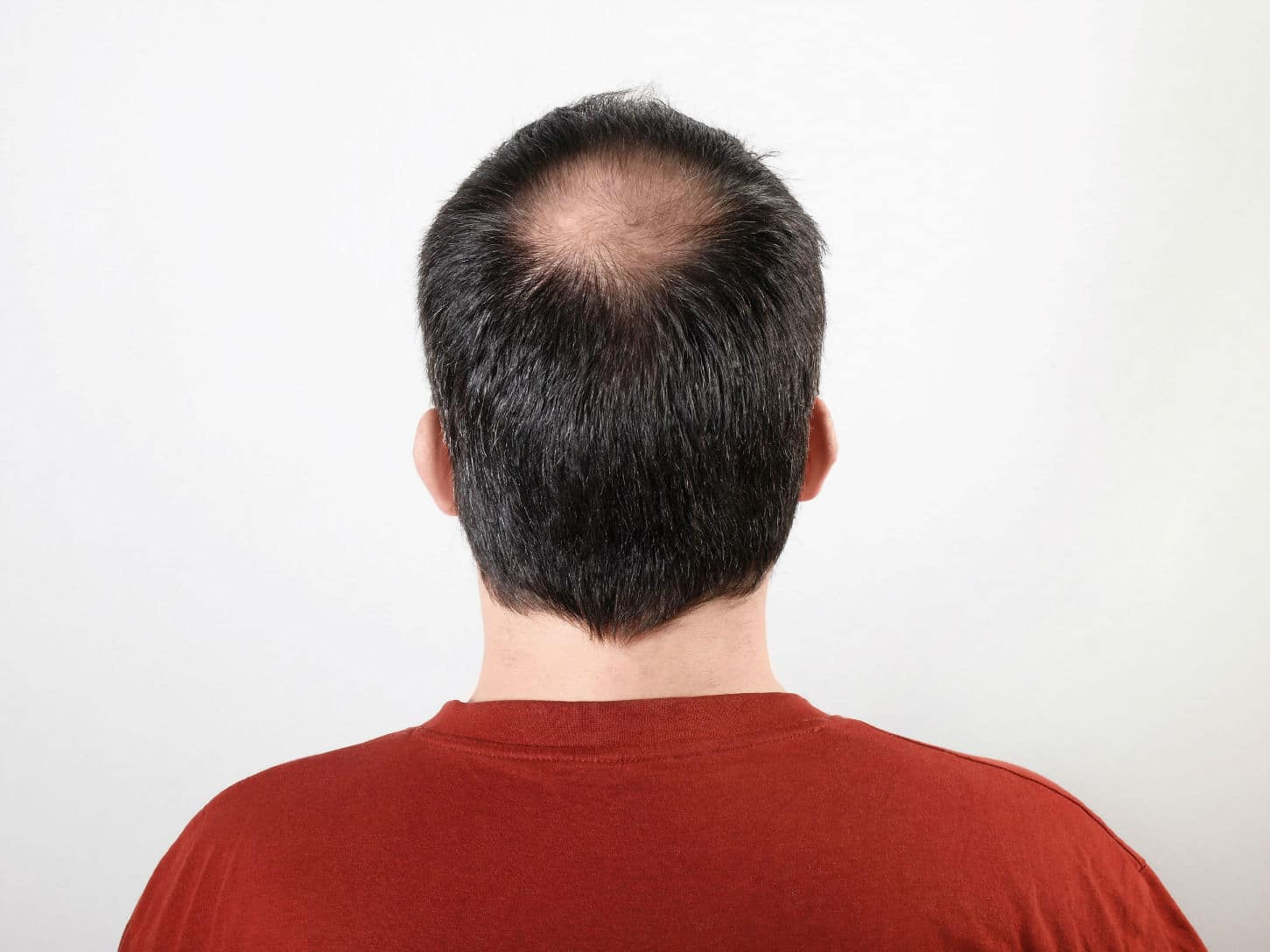 Hair Loss on Mans Head Indicating the Hair Loss Pattern Stock Image   Image of scalp crown 210798153