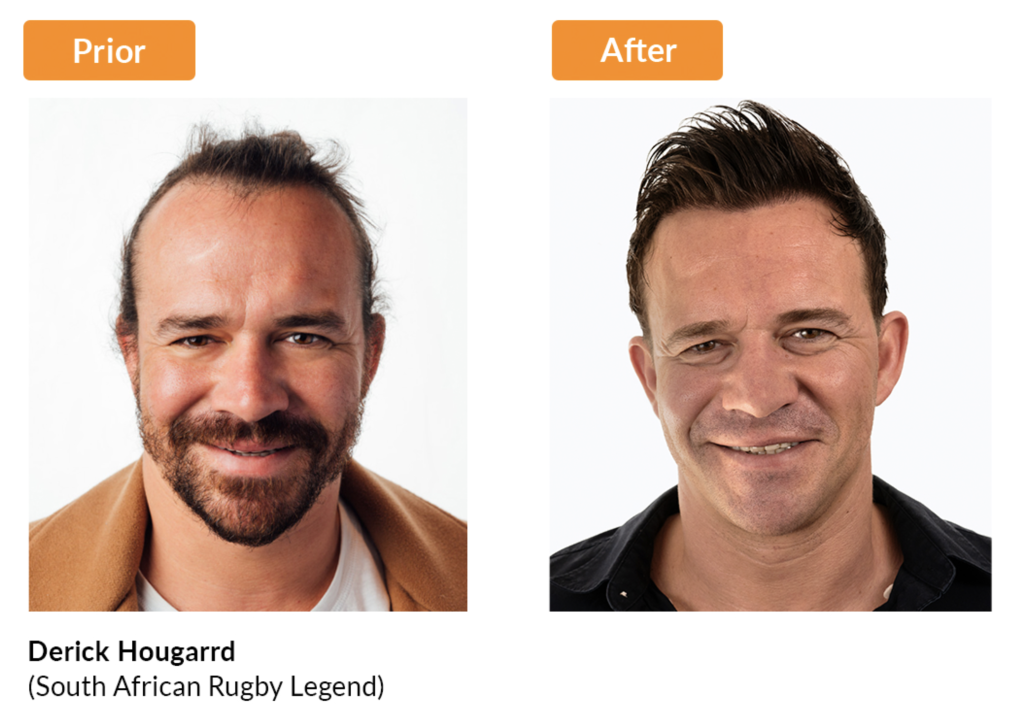 Before After Strand By Strand Hair Transplant