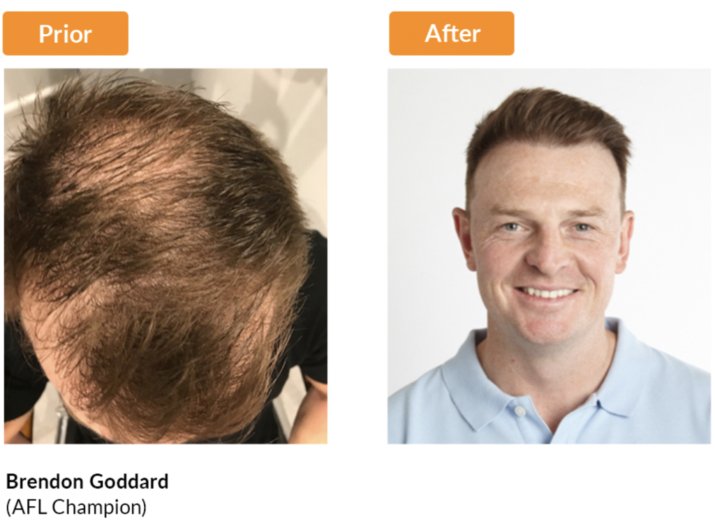 Brendon Goddard Before After